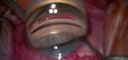 Ab Interno Canaloplasty With VIA360