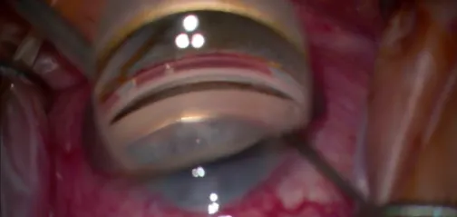 Ab Interno Canaloplasty With VIA360