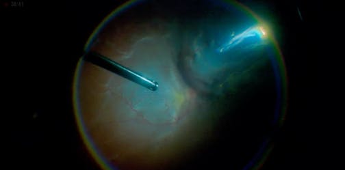 A Reshaping Transformative Vitrectomy for Advanced PVR
