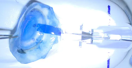 DMEK in Complex Anatomy: Donor Preparation and Endoglide Insertion in a Post-PK and Vitrectomy Eye