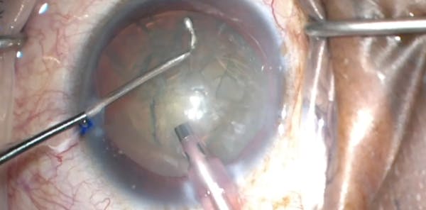 Nuclear Scooping, Back-Cracking, and Capsule Polishers: Techniques and Instruments for Nucleus Disassembly thumbnail