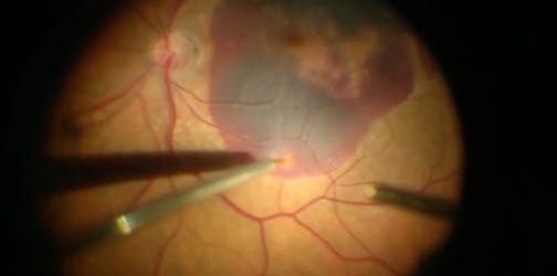 Subretinal tPA for Hemorrhage