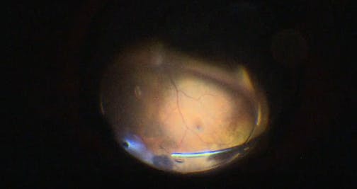 Vasoproliferative Tumor-Related Cystoid Macular Edema