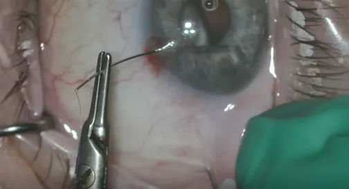 Dislocated IOL, Suture Refixation, Pars Plana Needle Assist