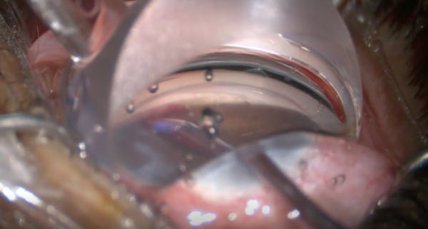 AlloFlo Quadruple Implant Placement and C-Rex Goniotomy thumbnail