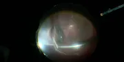 Subretinal Bleeding During Retinal Detachment Repair