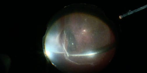 Subretinal Bleeding During Retinal Detachment Repair