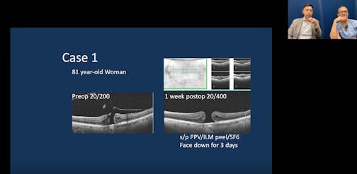 Episode 17 Part 1: Tips and Tricks During Complex Surgery