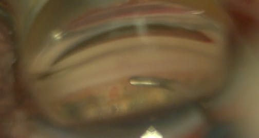 Pearls for Hydrus Microstent Placement