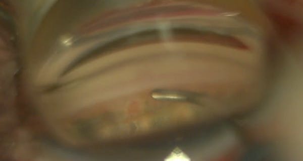 Pearls for Hydrus Microstent Placement thumbnail