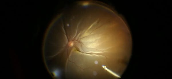 Management of Preretinal Hemorrhage Due to Forceps Trauma During ILM Peeling thumbnail