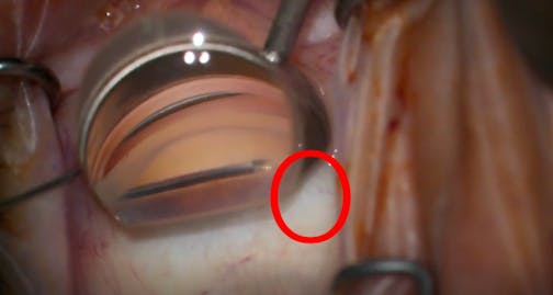 Intraoperative Pearls for Viscodilation of Schlemm Canal With the iTrack Advance