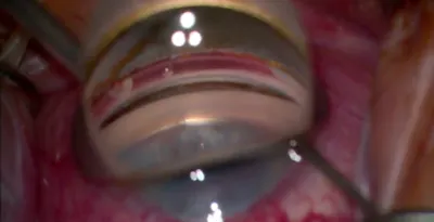 Intraoperative Pearls for Viscodilation of Schlemm Canal With VIA360 thumbnail