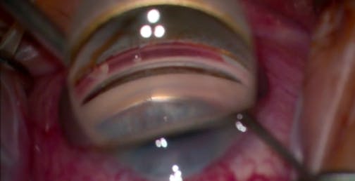 Intraoperative Pearls for Viscodilation of Schlemm Canal With VIA360