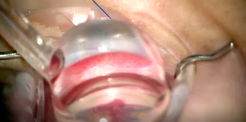 OVD Sweep for Angle-Based Surgery