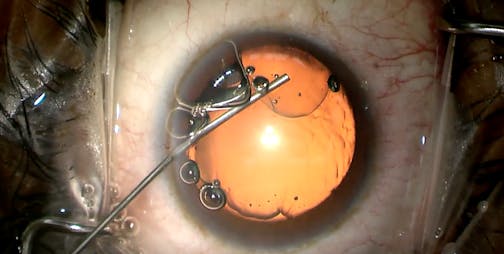 Sideways Softshell Technique for Angle-Based Surgery