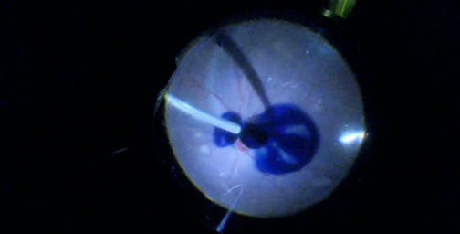 Longstanding Retinal Detachment