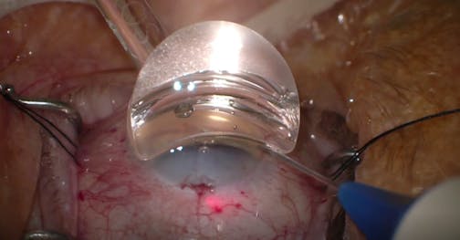 Episcleral Vessel Blanching With iTrack