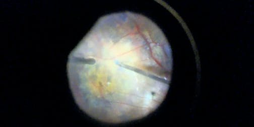 Posterior Retinal Detachment in Myopic Eye With Macular Hole