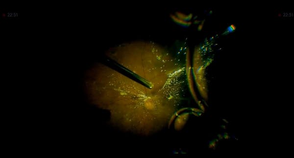 PDR and TRD With Fibrous Tissue Removal and Management of PVD and Asteroid Hyalosis thumbnail
