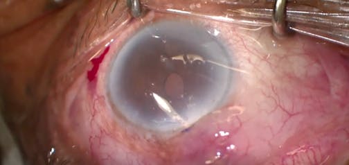 Aqualumen Subconjunctival Bypass