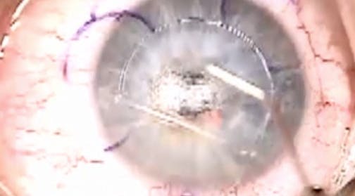 Removal of Near Vision Raindrop Inlay