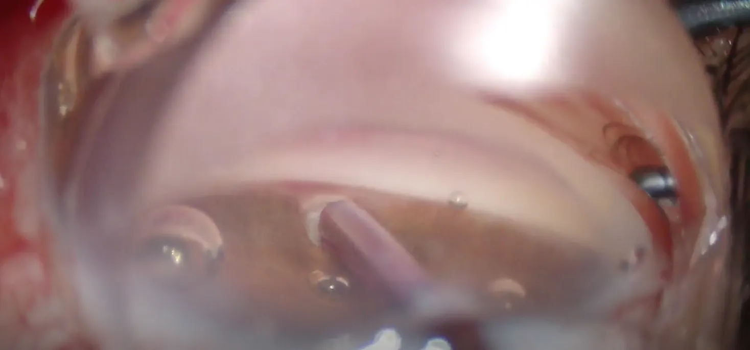 AlloFlo: Spatulated Cannula for Cleft Creation - Eyetube