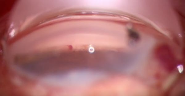 Interventional Glaucoma: iTrack Canaloplasty and iDose thumbnail