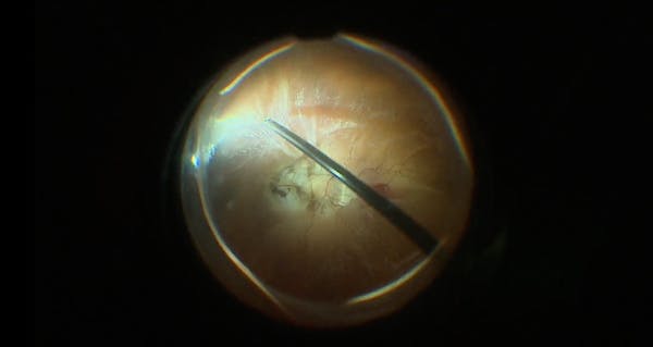 Highly Myopic Retinal Detachment With Vitreoschisis thumbnail