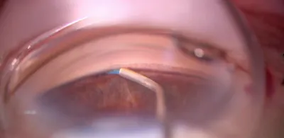 Omni Edge Surgical System Teaching Video thumbnail