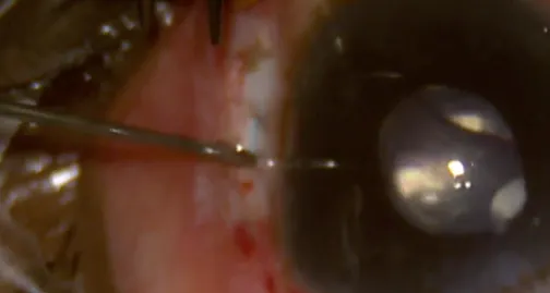 Modified Scleral Tunnel Technique in Case of Dropped Tension Ring and Three-Piece IOL