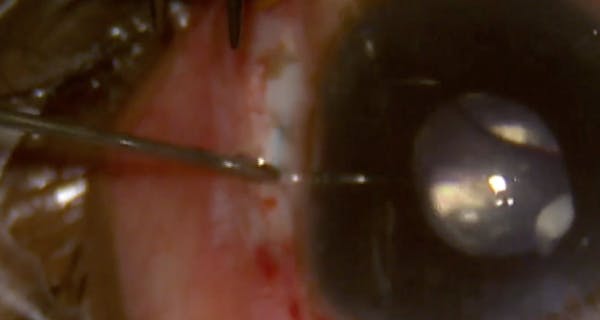 Modified Scleral Tunnel Technique in Case of Dropped Tension Ring and Three-Piece IOL thumbnail