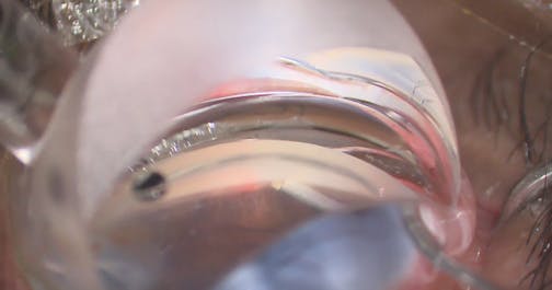 iTrack Advance: Second Case of Hypervascular Conjunctiva