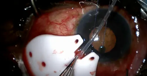 Cut Tube Mishaps