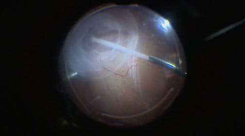 Secondary Detachment With Retinal Slippage