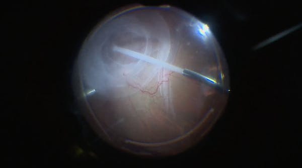 Secondary Detachment With Retinal Slippage thumbnail