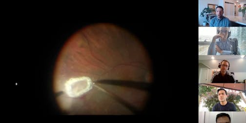 Episode 18 Part 2: Vitreoretinal Surgery in Uveitis