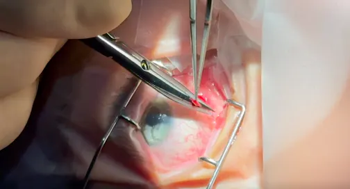 Subconjunctival Triamcinolone Removal