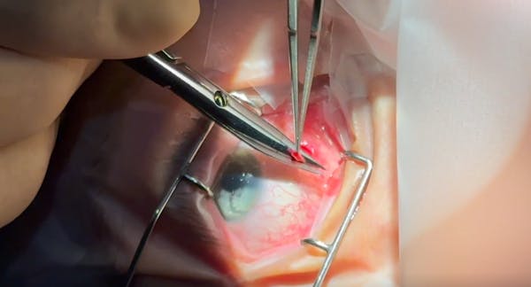 Subconjunctival Triamcinolone Removal thumbnail