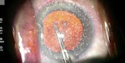 The Cornea and I