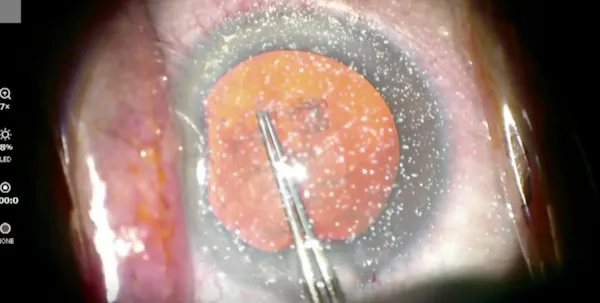 The Cornea and I thumbnail