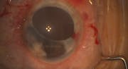 DMEK in Complex Eyes Part 1