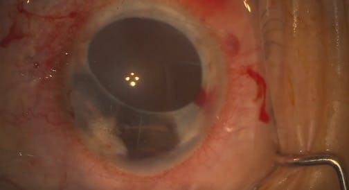 DMEK in Complex Eyes Part 1