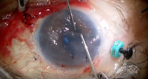 DMEK in Complex Eyes Part 2