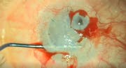Mini DSEK for Corneal Perforations
