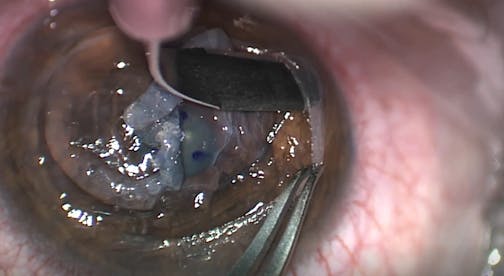 Peripheral Corneal Thinning: Donor Flange