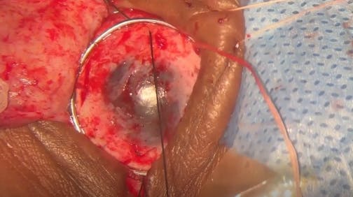 Technique of OOKP Surgery