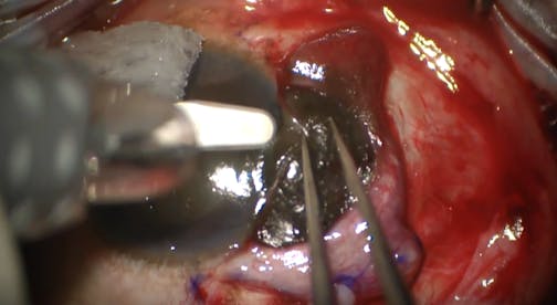 Surgical Management of Surface Tumors