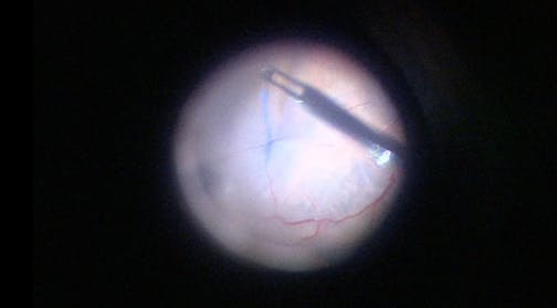 Retinal Detachment With Subluxated Lens and Posterior PVR