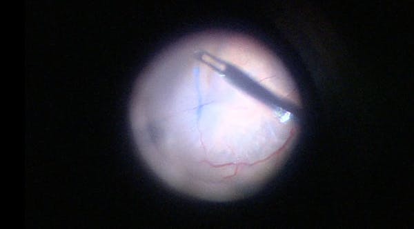 Retinal Detachment With Subluxated Lens and Posterior PVR thumbnail
